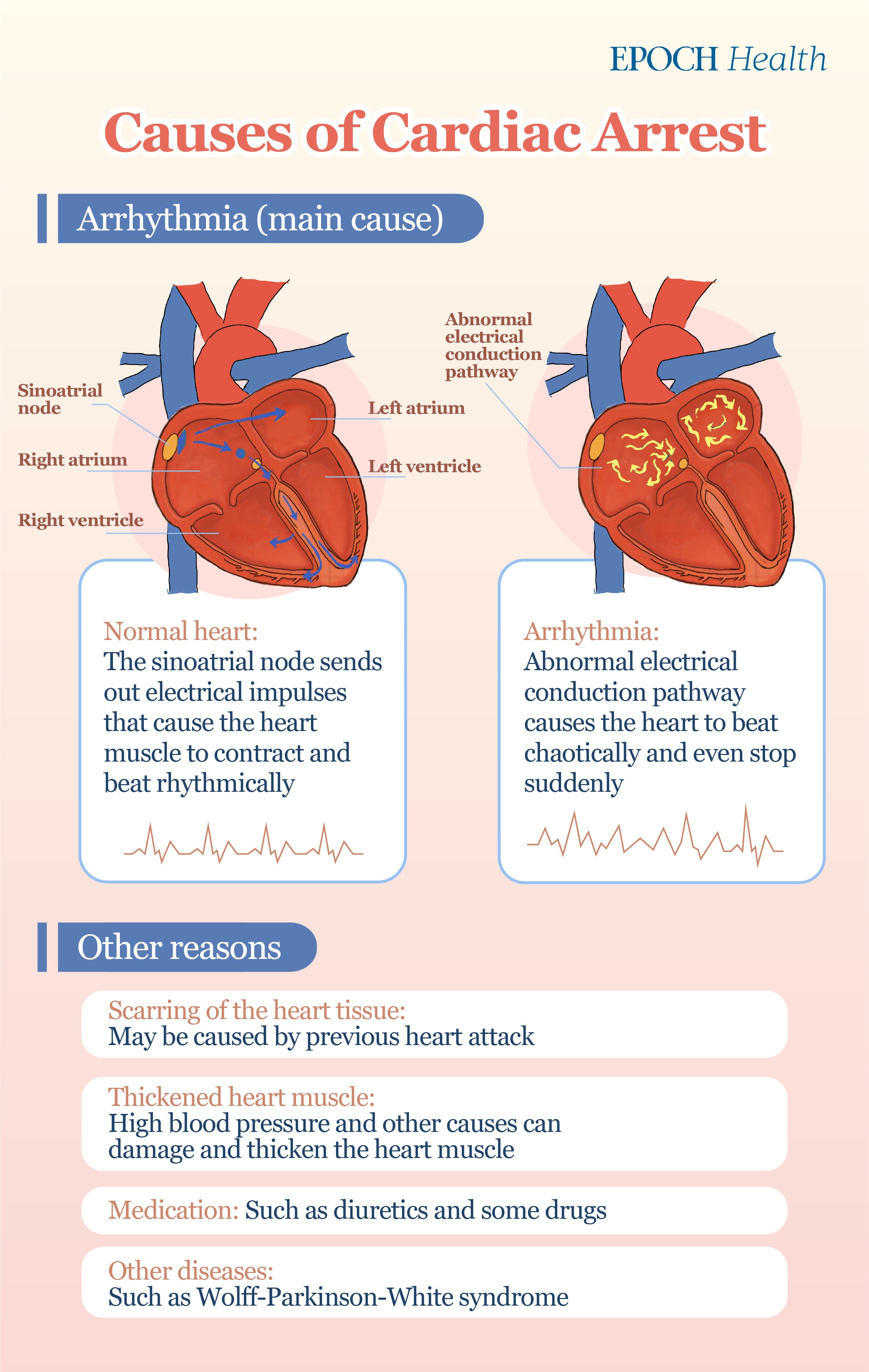 Cardiac Arrest Complete Guide: Main Cause, 2 First Aid Moves to Prevent ...