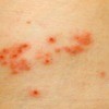 Shingles Rash