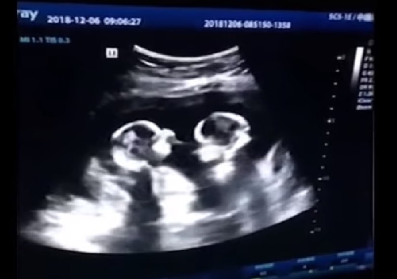 Identical twins spotted ‘fighting’ inside mother’s womb during ...