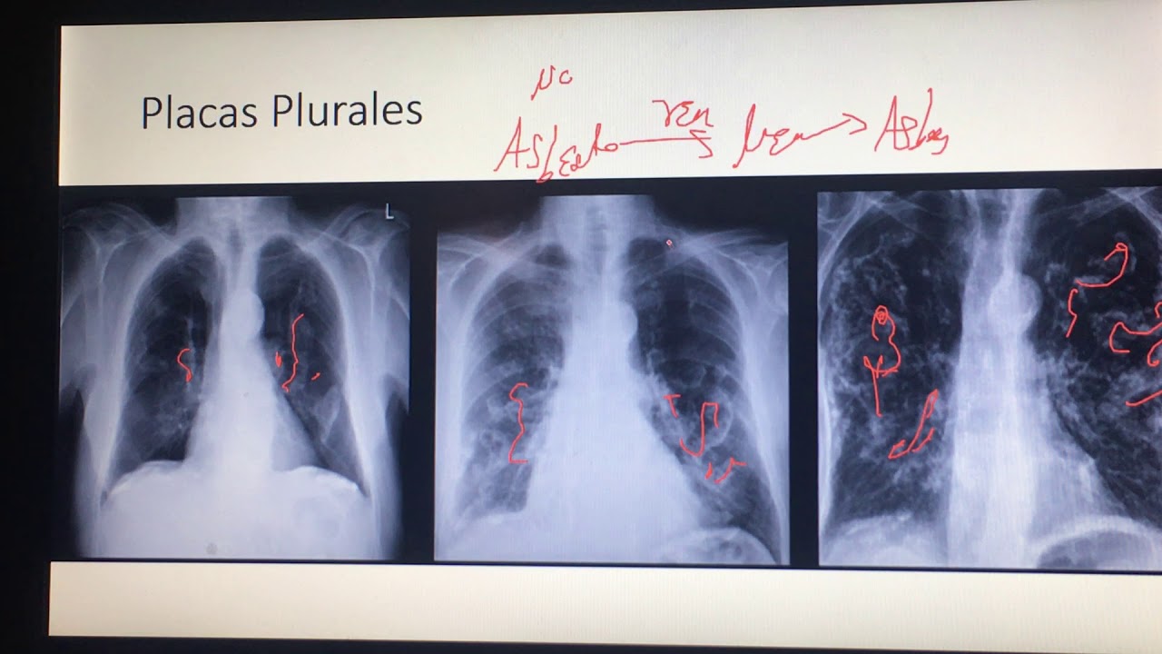 ¿Qué significa engrosamiento pleural biapical? – LIB Answers