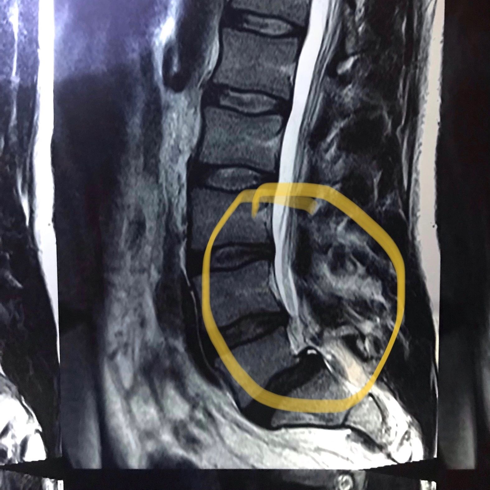 Herniated discs