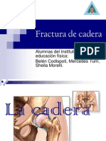 Fractura de Cadera