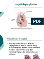 Tricuspid Regurgitation