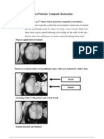 Direct Posterior Composite 1