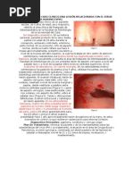 Reporte de Un Caso Clinico Una Lesión Relacionada Con El Virus Papiloma Humano