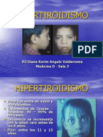 Hipertiroidismo en Pediatria