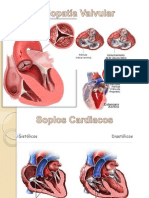 Cardiopatia Valvular