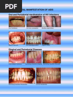 Oral and Periodontal Manifestation of HIV Infections