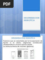 Degeneracion Hidropica