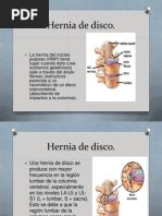 Hernia de Disco