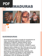 Seminario Queimaduras