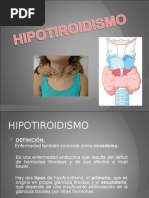 HIPERTIROIDISMO