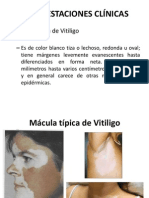 Vitiligo