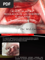 Alveoloplastia y Regulación de Los Rebordes Alveolares