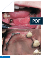 Los Implantes Como Apoyo A La Prótesis Removible