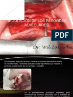 Alveoloplastia y Regulacion de Los Rebordes Alveolares