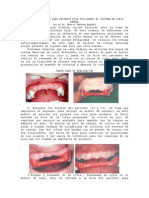 Toma de Impresion para Protesis Fija Utilizando El Sistema de Cofia Dental