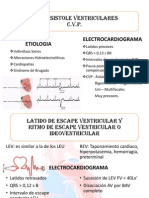 Extrasistole Ventriculares