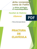 Fractura de Clavícula