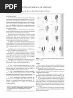 Luxofractura de Lisfranc