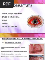 Conjuntivitis