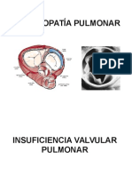 Valvulopatía Pulmonar