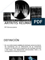 Artritis Reumatoide