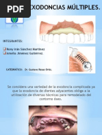 Exodoncias Múltiples