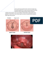 Laringitis Kronis