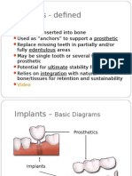 Implan Gigi