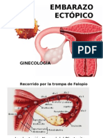 Embarazo Ectópico