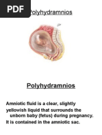 Over Distension of Uterus POLYHYDRAMNIOS