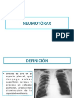 NEUMOTÓRAX