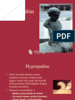 Hypospadia