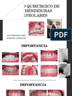 Manejo Quirúrgico de Las Hendiduras Alveolares