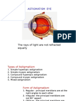 Astigmatism Eye: The Rays of Light Are Not Refracted Equally