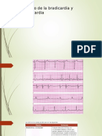 Bradicardia