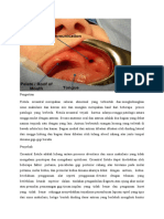 Oroantral Fistula