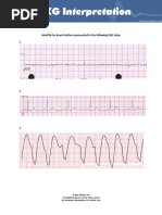 Identify The Heart Rhythm Represented in The Following EKG Strips