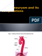 Abdominal Aortic Aneurysm