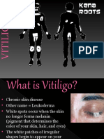 KenaLeen Cream and Vitiligo