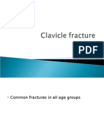 Clavicle Fracture