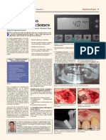 Complicaciones Implantologia