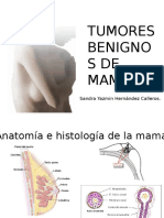 Adenoma de La Mama