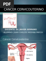 Cancer de Cervix 