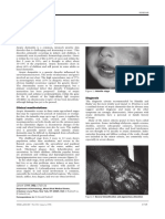 Atopic Dermatitis - 2 PDF