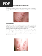 Infecciones Micóticas de La Piel