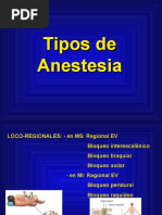 Tipos de Anestesia