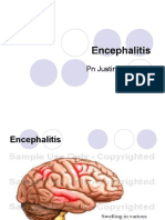 Encephilitis Presentation