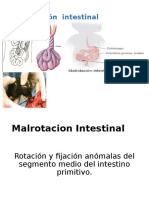 Malrotacion Intestinal